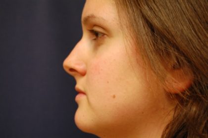 Rhinoplasty Before & After Patient #3384