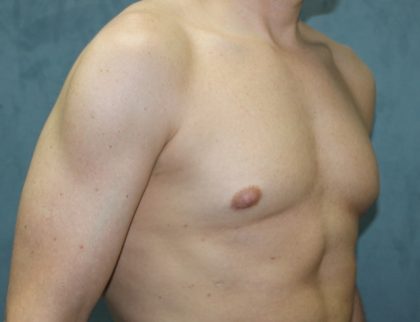 Gynecomastia Surgery Before & After Patient #3190