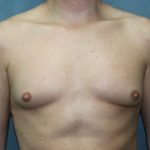 Gynecomastia Surgery Before & After Patient #3190