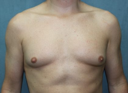 Gynecomastia Surgery Before & After Patient #3190