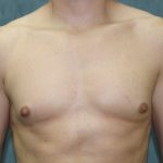 Gynecomastia Surgery Before & After Patient #3190