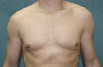 Gynecomastia Surgery Before & After Patient #3190