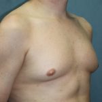 Gynecomastia Surgery Before & After Patient #3190