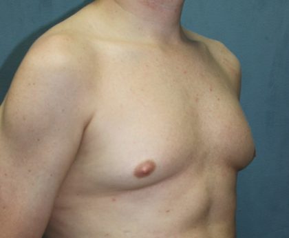 Gynecomastia Surgery Before & After Patient #3190