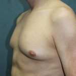Gynecomastia Surgery Before & After Patient #3190
