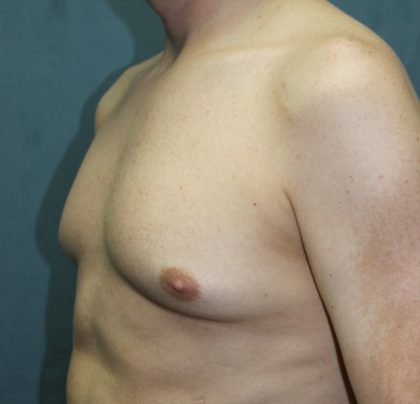 Gynecomastia Surgery Before & After Patient #3190