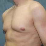 Gynecomastia Surgery Before & After Patient #3190