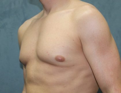 Gynecomastia Surgery Before & After Patient #3190