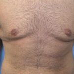 Gynecomastia Surgery Before & After Patient #3187