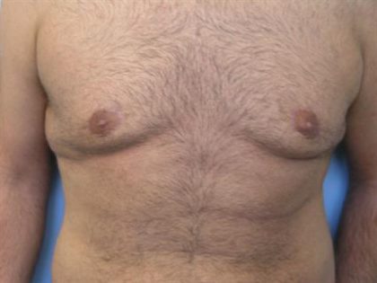 Gynecomastia Surgery Before & After Patient #3187