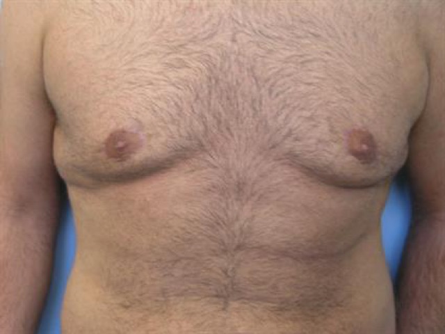 Gynecomastia Surgery Before & After Patient #3187