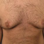 Gynecomastia Surgery Before & After Patient #3187