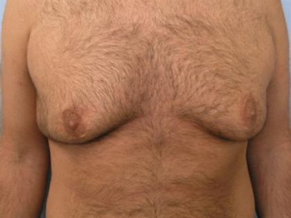 Gynecomastia Surgery Before & After Patient #3187