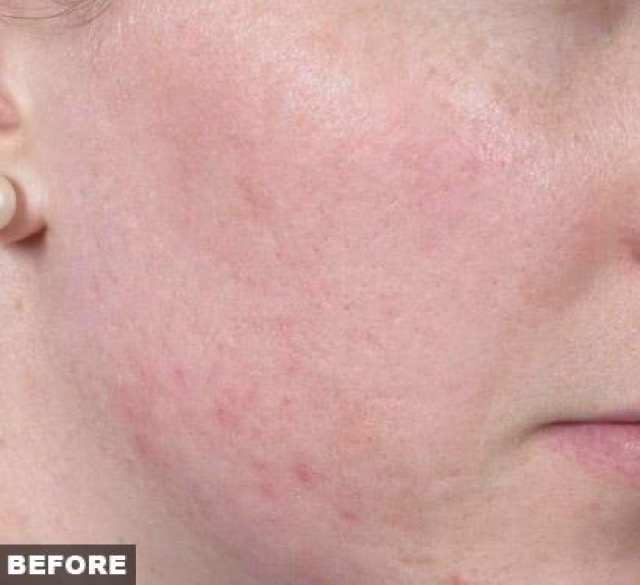 Fraxel Before & After Patient #3178