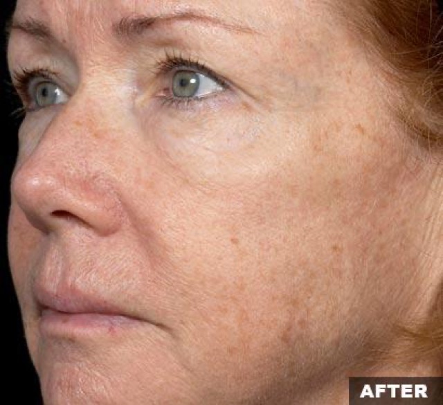 Fraxel Before & After Patient #3175