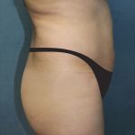 Tummy Tuck Before & After Patient #2949