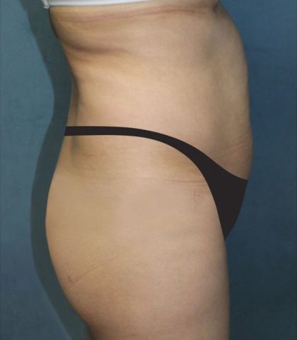 Tummy Tuck Before & After Patient #2949