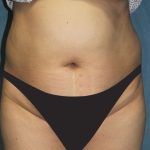 Tummy Tuck Before & After Patient #2949