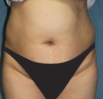 Tummy Tuck Before & After Patient #2949