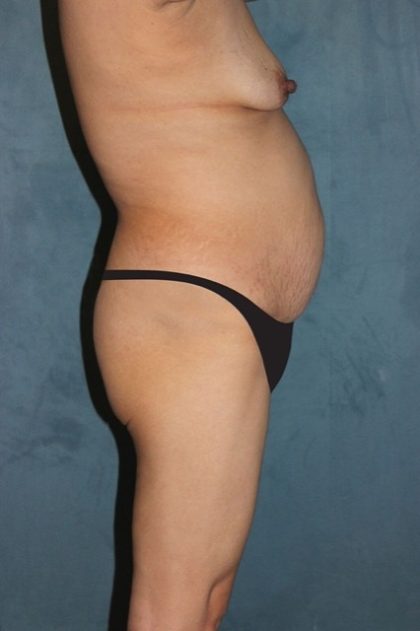 Tummy Tuck Before & After Patient #2954