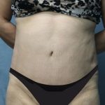 Tummy Tuck Before & After Patient #2954
