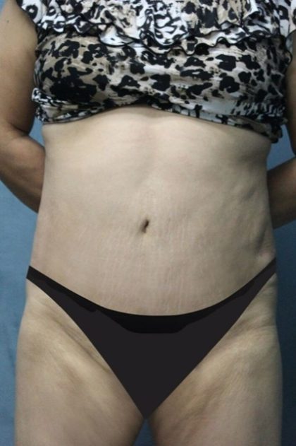 Tummy Tuck Before & After Patient #2954