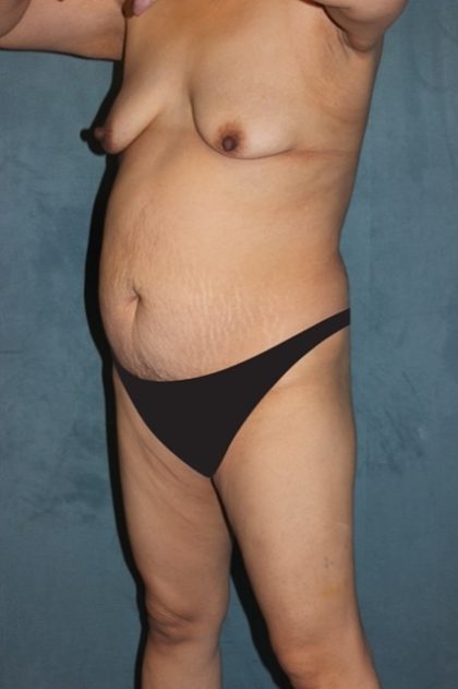 Tummy Tuck Before & After Patient #2954