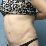 Tummy Tuck Before & After Patient #2954