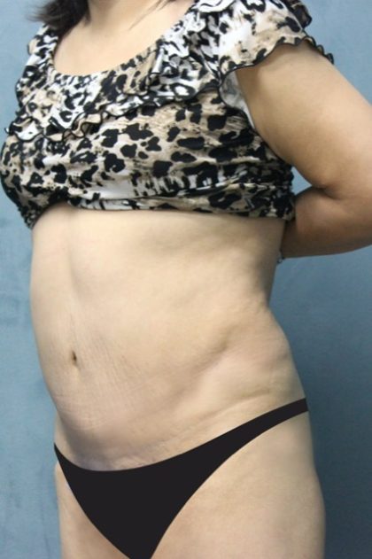 Tummy Tuck Before & After Patient #2954