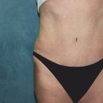 Tummy Tuck Before & After Patient #2963