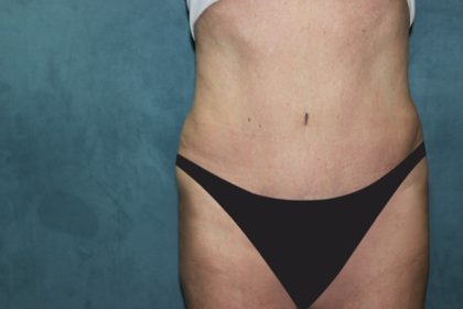 Tummy Tuck Before & After Patient #2963