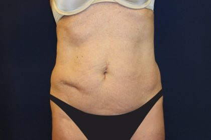 Tummy Tuck Before & After Patient #2963