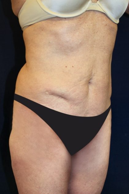 Tummy Tuck Before & After Patient #2963