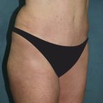 Tummy Tuck Before & After Patient #2963