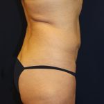 Tummy Tuck Before & After Patient #2963