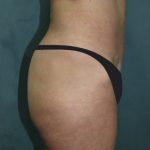 Tummy Tuck Before & After Patient #2963