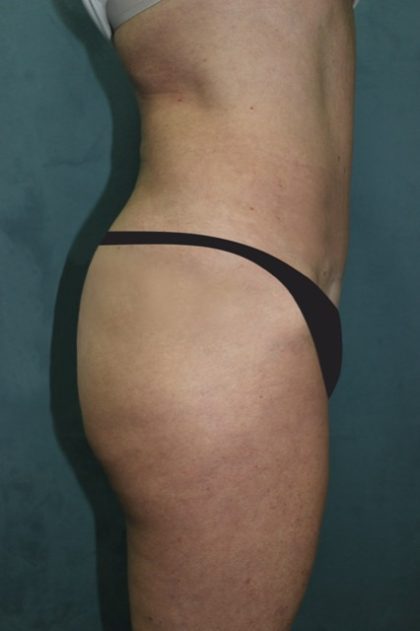 Tummy Tuck Before & After Patient #2963