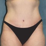 Tummy Tuck Before & After Patient #2944