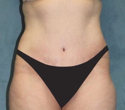 Tummy Tuck Before & After Patient #2944