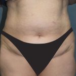 Tummy Tuck Before & After Patient #2944