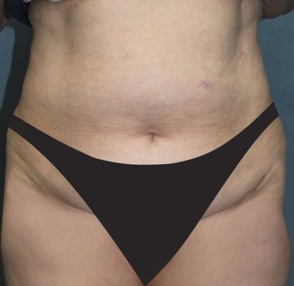 Tummy Tuck Before & After Patient #2944