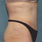 Tummy Tuck Before & After Patient #2944