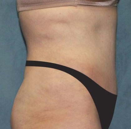 Tummy Tuck Before & After Patient #2944