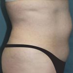 Tummy Tuck Before & After Patient #2944