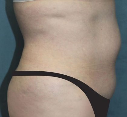 Tummy Tuck Before & After Patient #2944