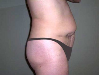 Tummy Tuck Before & After Patient #2927