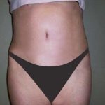 Tummy Tuck Before & After Patient #2927