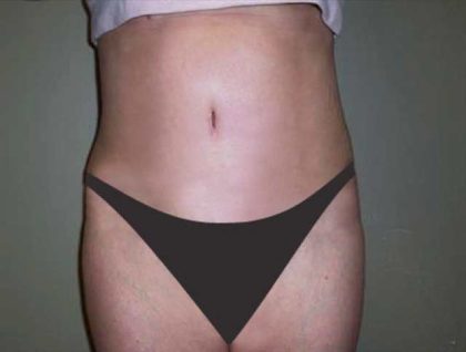 Tummy Tuck Before & After Patient #2927