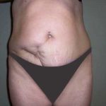 Tummy Tuck Before & After Patient #2927