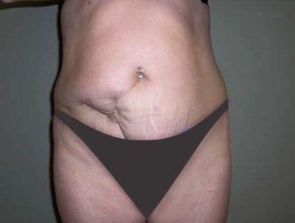 Tummy Tuck Before & After Patient #2927